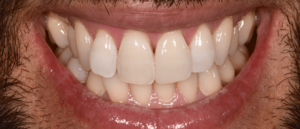 Eclaircissement-Blanchiment-Dentaire