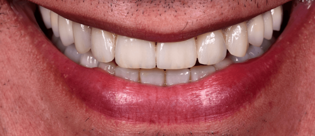 Complete dental cosmetic rehabilitation