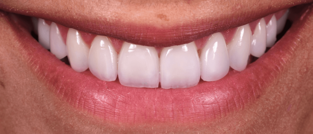 Pose de facettes dentaires