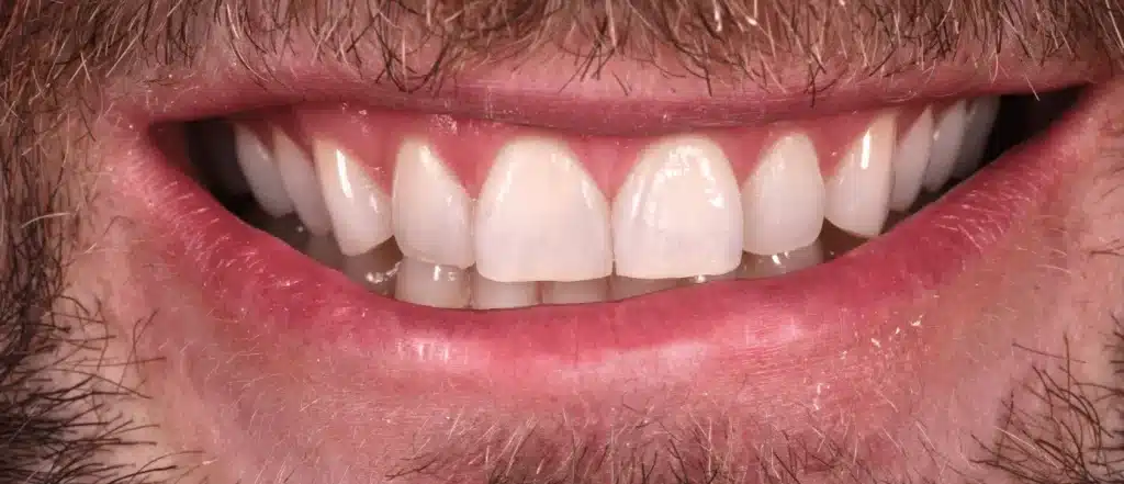 Cas pratique d'après la pose de facettes dentaires