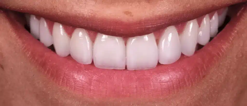 Dental Bone Graft Surgeon in Paris