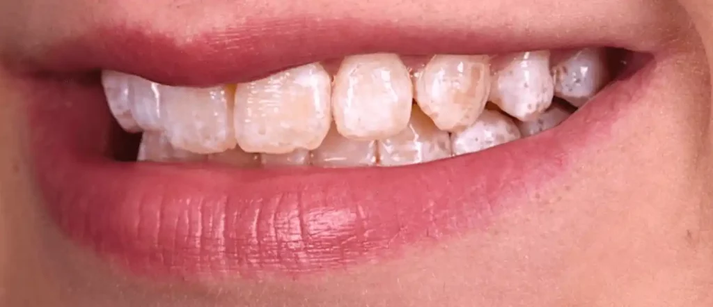 Fluorose dentaire traitement - avant