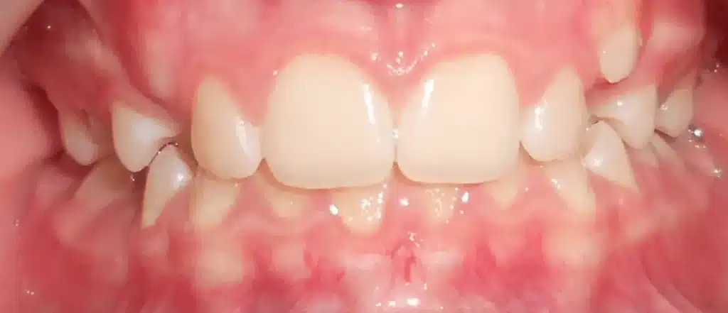 Orthodontie Paris alignement dentaire avant