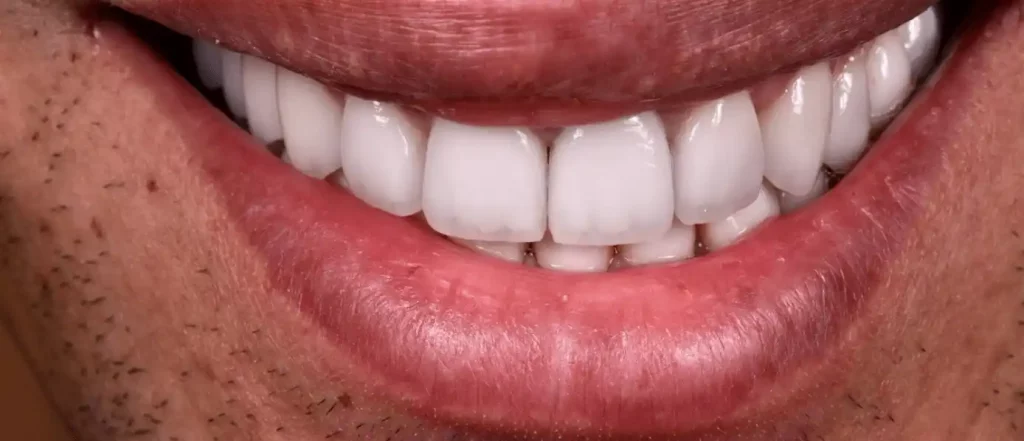 Traitement de la fluorose - après