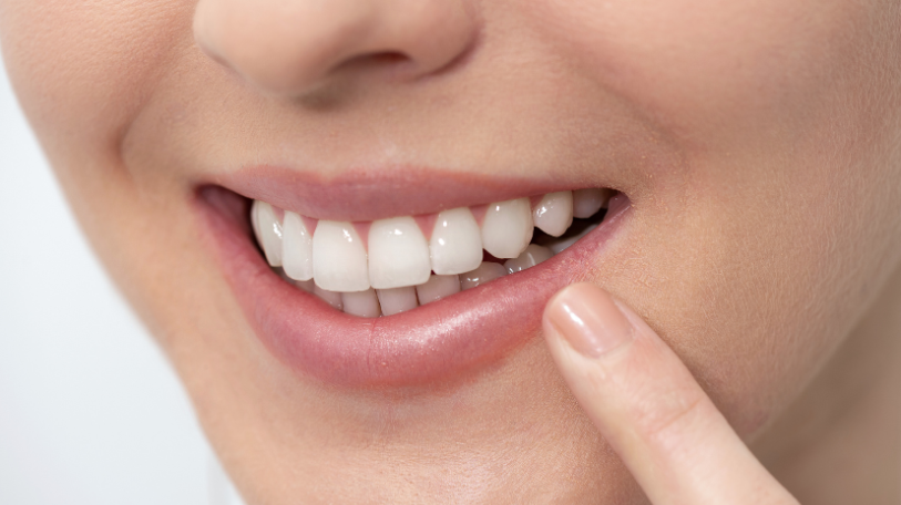 blanchiment dentaire