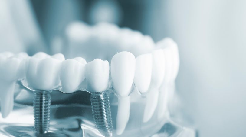 implants dentaires fast dentisterie